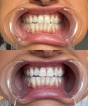 Teeth Whitening Strips for Sensitive Teeth | Professional Whitening at Home